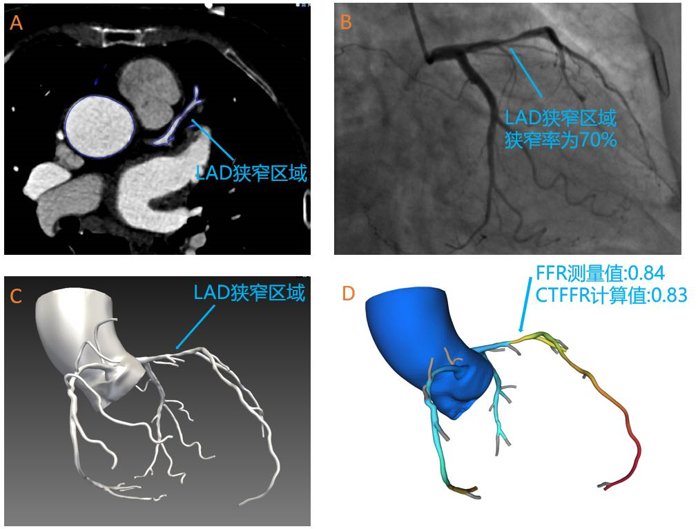 奧泰康助力睿心醫(yī)療—《冠狀動(dòng)脈供血功能（CT-FFR）評(píng)估軟件》產(chǎn)品完成創(chuàng)新審評(píng)及臨床試驗(yàn)